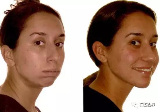 凸嘴龅牙如何变身美人,轻微龅牙如何整形