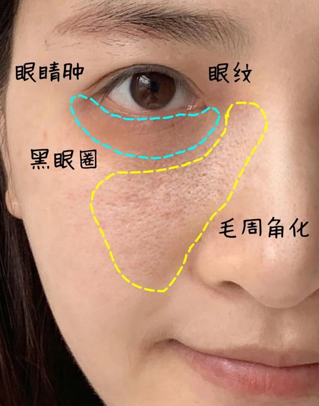 眼睛鳞状上皮增生伴过度角化,眼睛下面的小颗粒是毛周角化吗