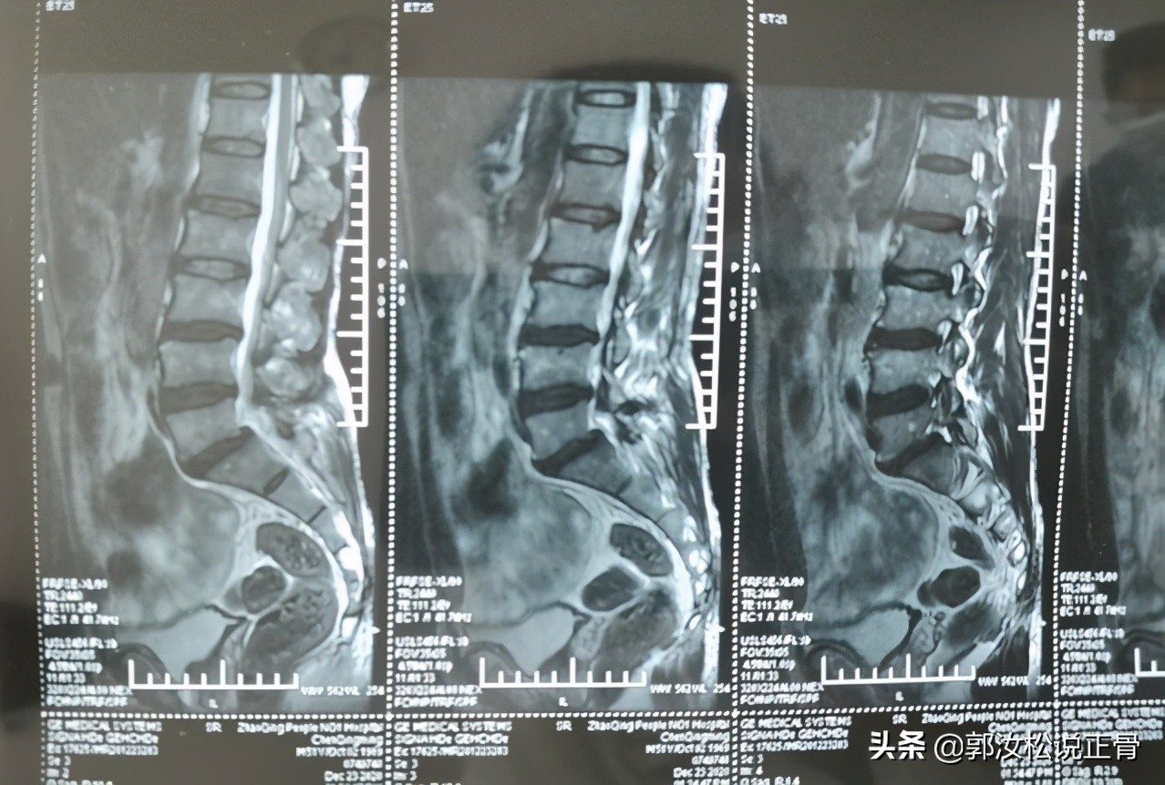 腰椎滑脱病例分析,腰椎滑脱症及手术方法的进展