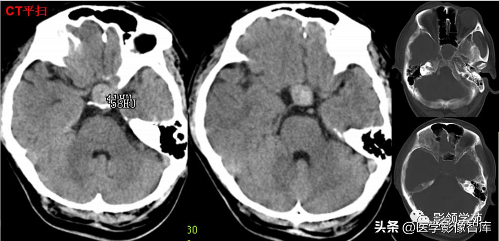鞍区肿瘤做什么检查得出来,鞍区肿瘤的影像学鉴别