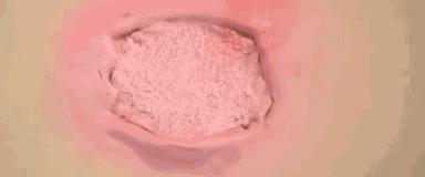 腹部切口感染正确处理方法,切口感染的原因有哪些