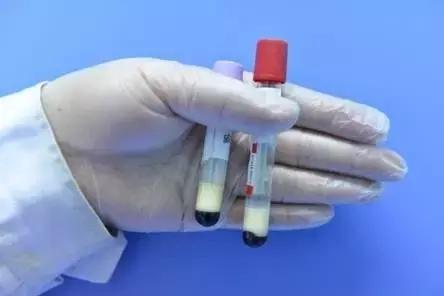 抽血颜色发黑是什么原因,抽血血液颜色发黑怎么回事