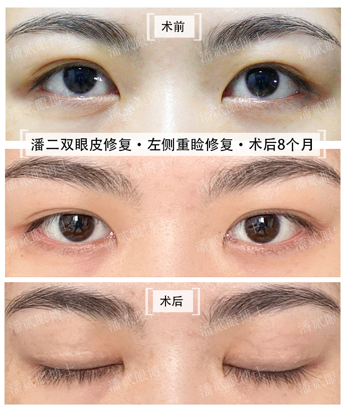 双眼皮修复案例真实,双眼皮修复会越来越糟吗