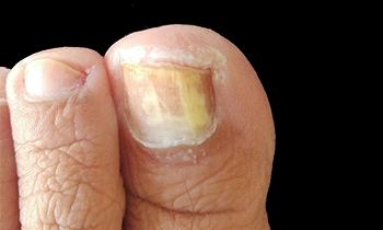 甲沟炎怎么办教你一招解决,甲沟炎怎么办用什么抗生素