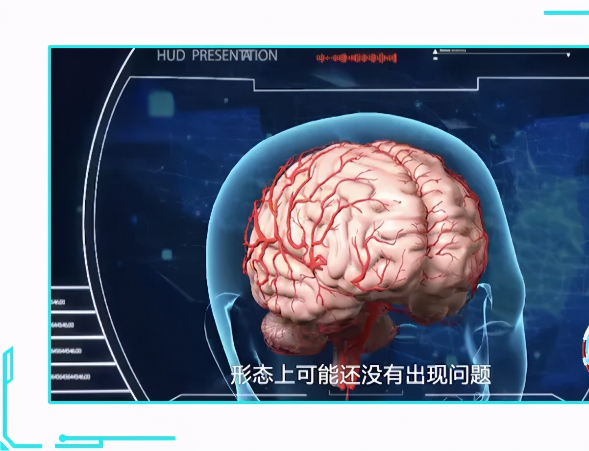 40多岁记忆力下降是痴呆的征兆吗,怎么分辨记忆力下降和老年痴呆