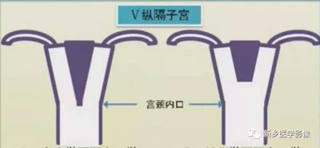 子宫发育异常,应想到的6大类常见畸形