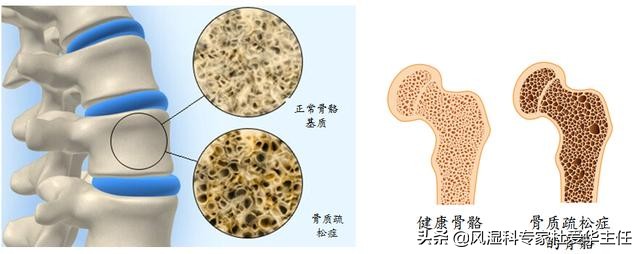 类风湿造成骨质疏松有什么影响,类风湿关节炎导致骨质疏松怎么办