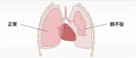 早期肺癌术后第五年又出现结节,肺癌术后20多天伤口不愈合流液体