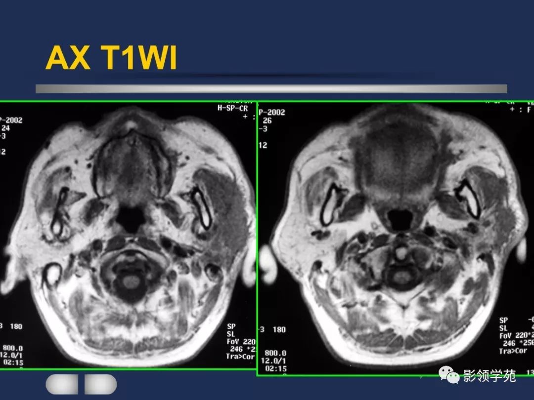 腮腺疾病影像学诊断,腮腺肿块影像诊断