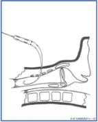 干货：气管切开术及护理措施