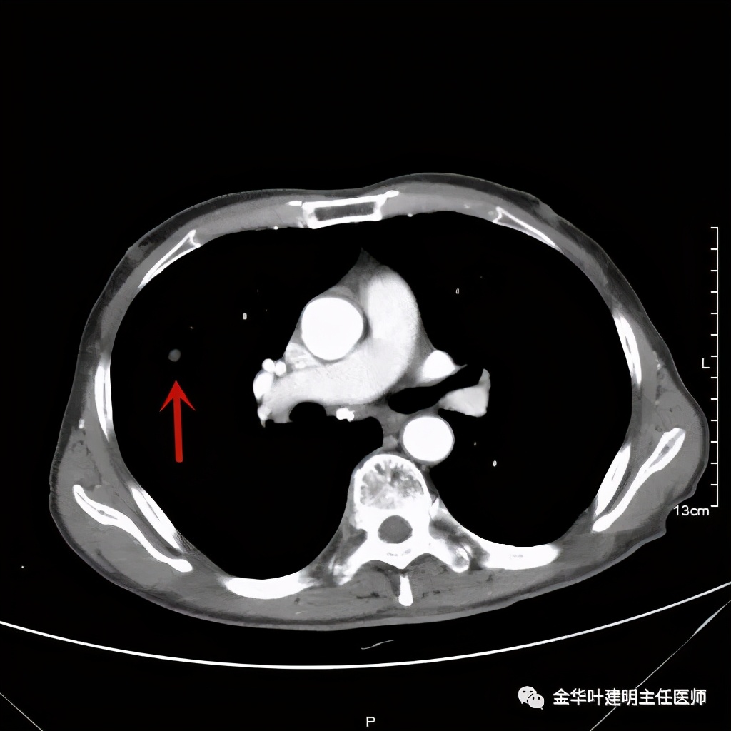 左肺占位被安排穿刺活检是肺癌吗,肺癌肺部穿刺有什么危险