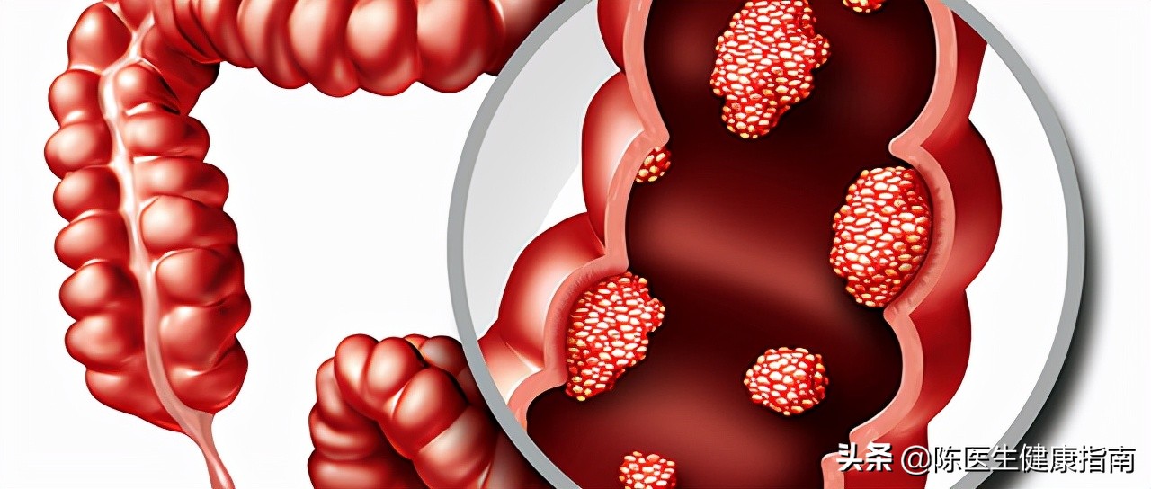 肠内有息肉都会出现哪些症状,肠内有息肉会有何症状