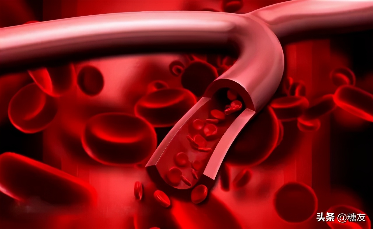 磁疗治疗糖尿病有效果吗,糖尿病患者定期吃药能控制好吗