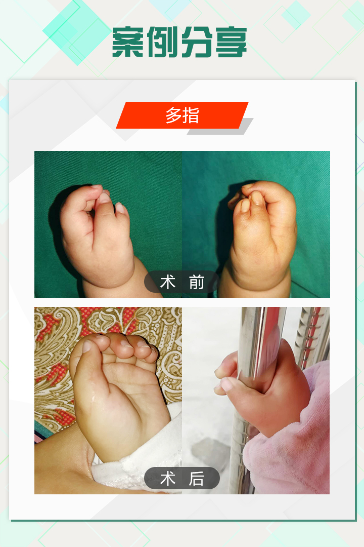 手足外科陈江海微博,手外科专家陈江海