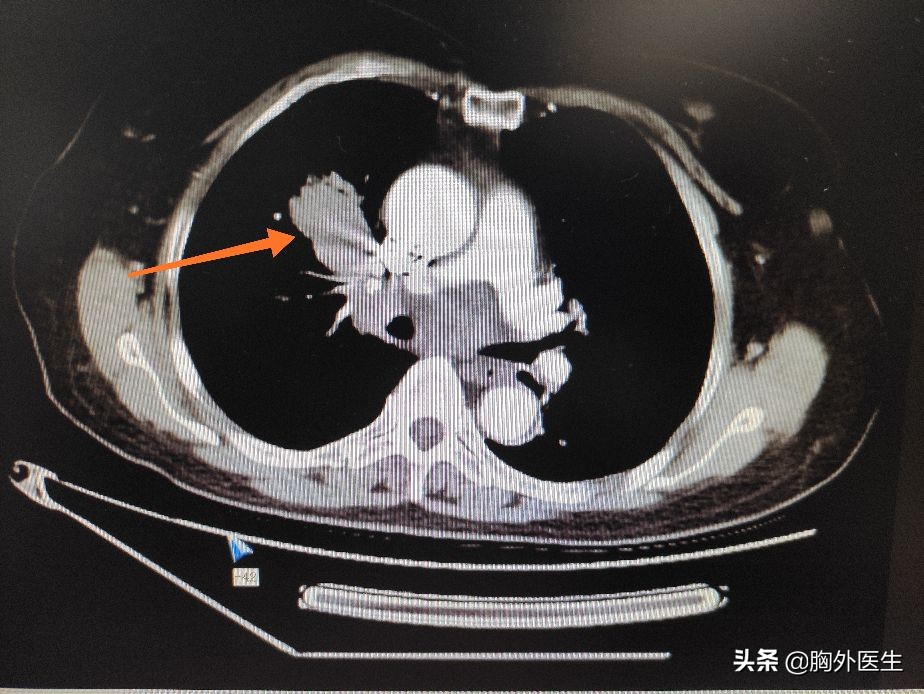 得了癌症,手术、放化疗、靶向、免疫治疗该怎么选?