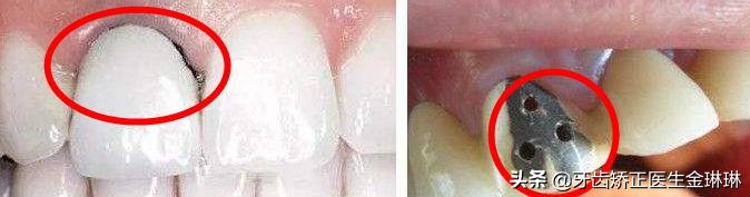 烤瓷牙不密合会导致牙疼吗,烤瓷牙不密合是什么原因引起的