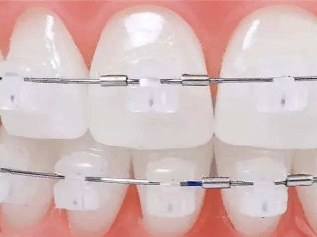 正畸价格会下降吗,正畸矫正为啥这么贵