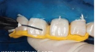 门牙裂了一条缝,门牙有缝的女人