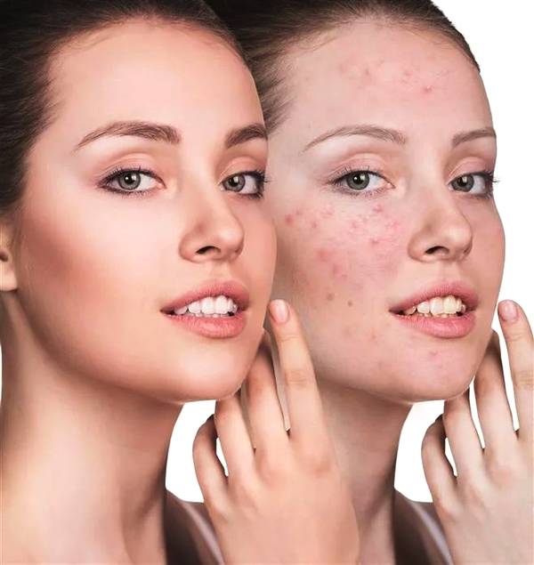 脸干燥脱皮怎么保湿护肤,脸部很干燥脱皮紧绷怎么办