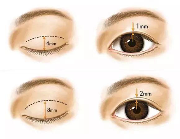10毫米双眼皮可以恢复自然不,割双眼皮7.5毫米和8毫米的区别