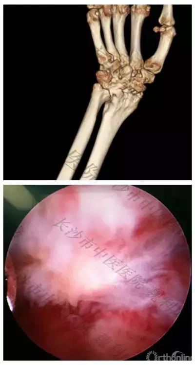 腱鞘囊肿除了手术还有什么办法,下颚有囊肿可以做穿刺手术