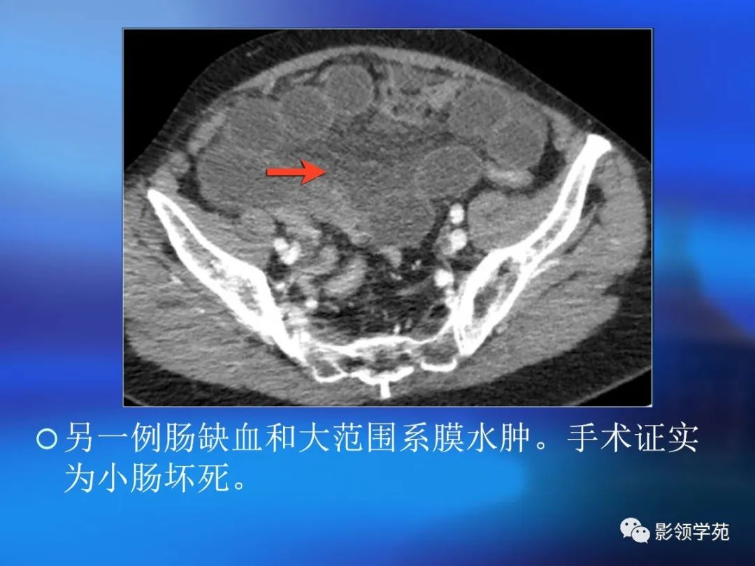 肠道内壁增厚,肠道扩张ct表现