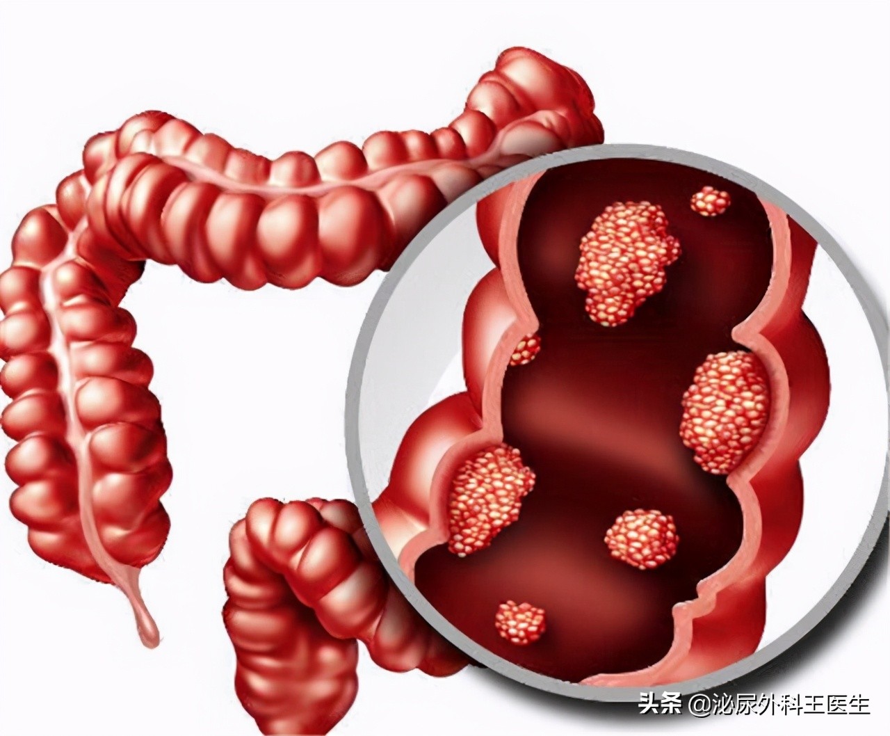 直肠粘膜下肿物处理,直肠肿物怎么办