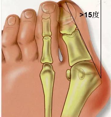 中老年女性拇外翻能矫正过来吗,女性脚拇指外翻原因