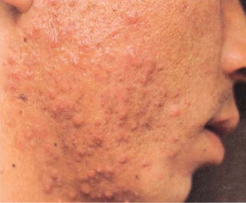 青春痘皮肤病如何治疗好,青春痘怎么治疗最好女学生