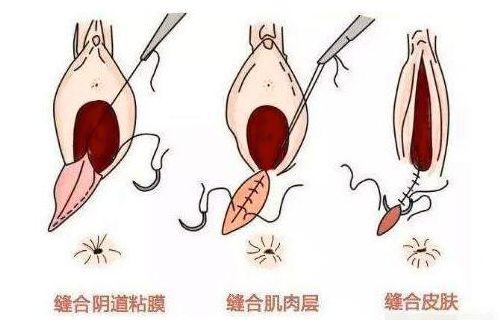 怎样才能不被侧切,分娩如何防止侧切