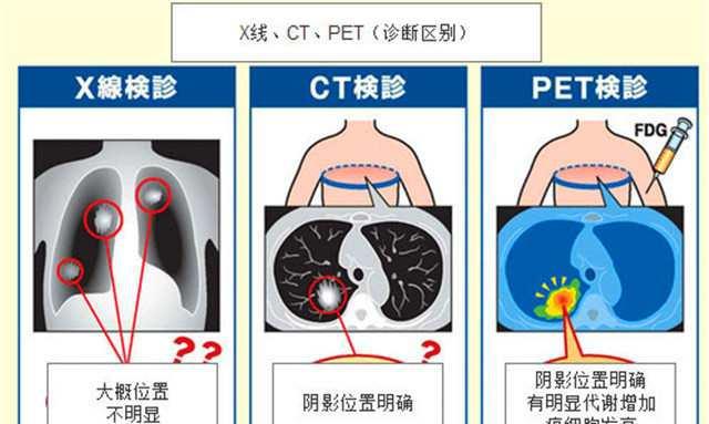 肺小结节的诊断,肺小结节的最佳治疗方法是什么