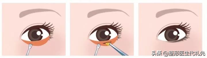 不开刀祛眼袋和开刀祛眼袋哪个好,微创祛眼袋和手术开刀哪种效果好