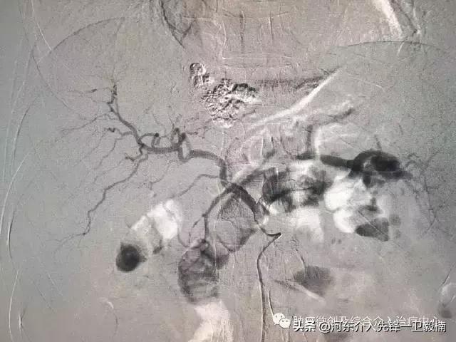 肝癌介入微创消融治疗,肝癌栓塞介入手术