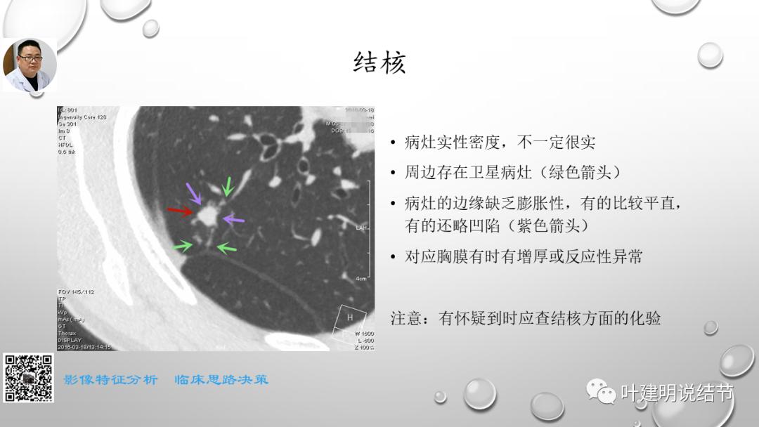 叶建明谈肺实性小结节视频,廖正银教授谈肺结节