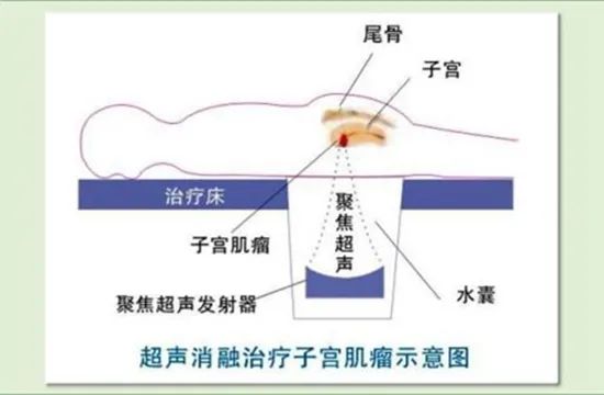 子宫肌瘤知识100条,子宫肌瘤七大误区