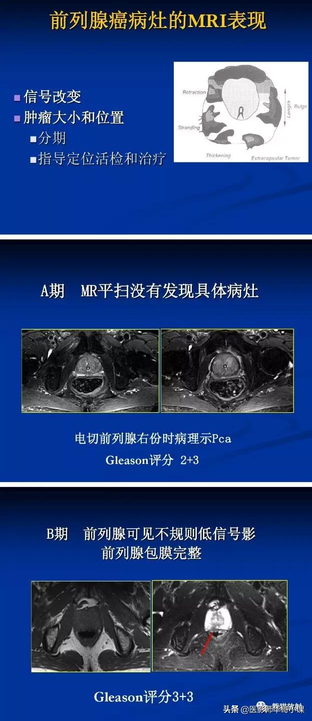 前列腺磁共振影像解剖,前列腺mri正常诊断报告模板