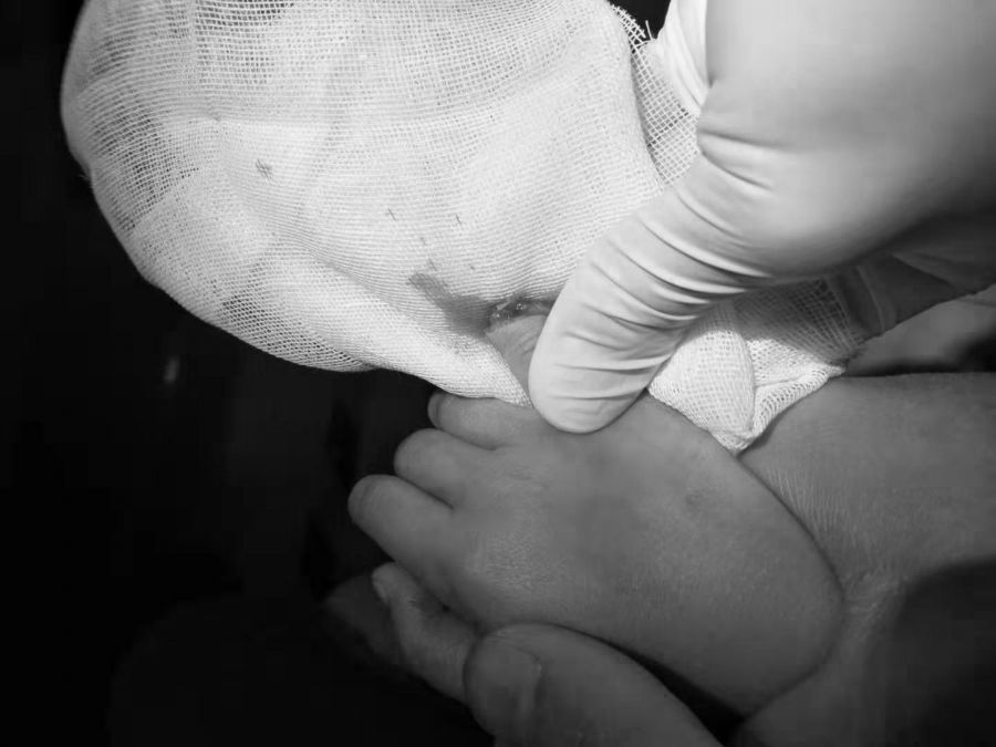 断指再植接动脉显微镜视频,穿针引线手术