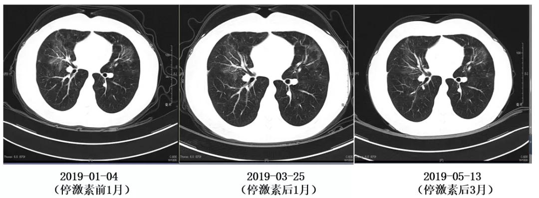 特发性肺炎一直用激素治疗,机化性肺炎住院治疗使用什么药物