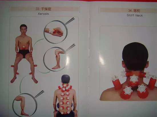 拔罐有哪些穴位图解,最全拔罐穴位疗法图解