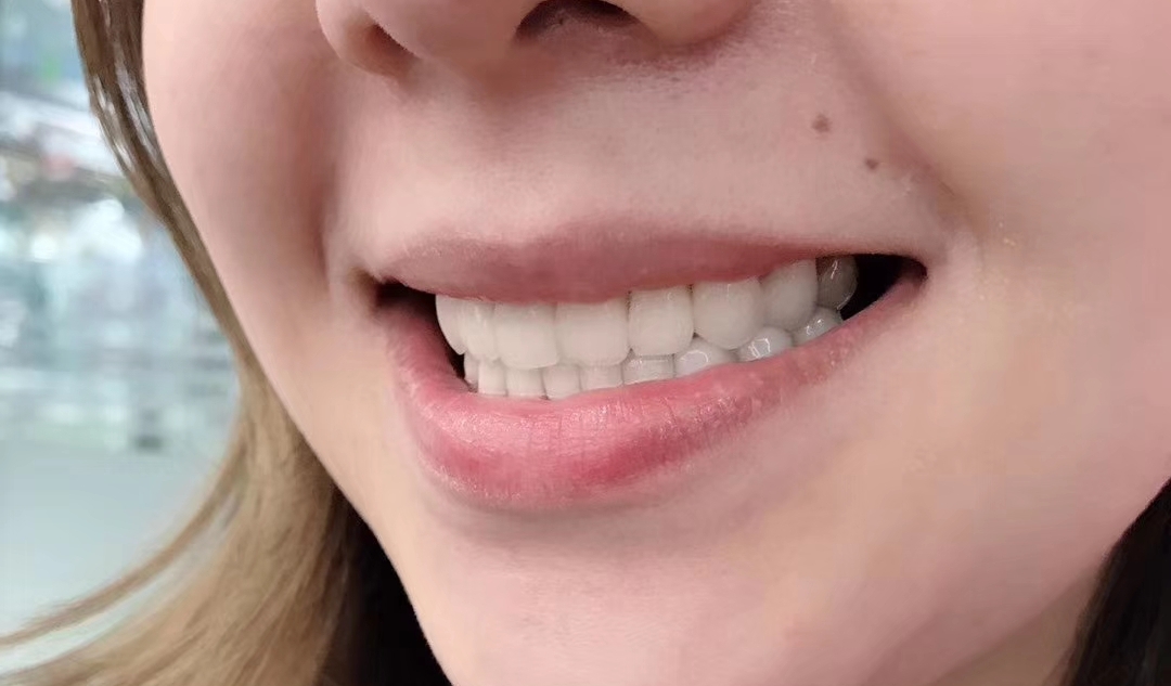 假牙套怎么种植牙,戴的假牙套与全瓷牙的感觉