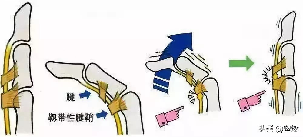 训练时肩膀弹响,训练时肩肘弹响严重