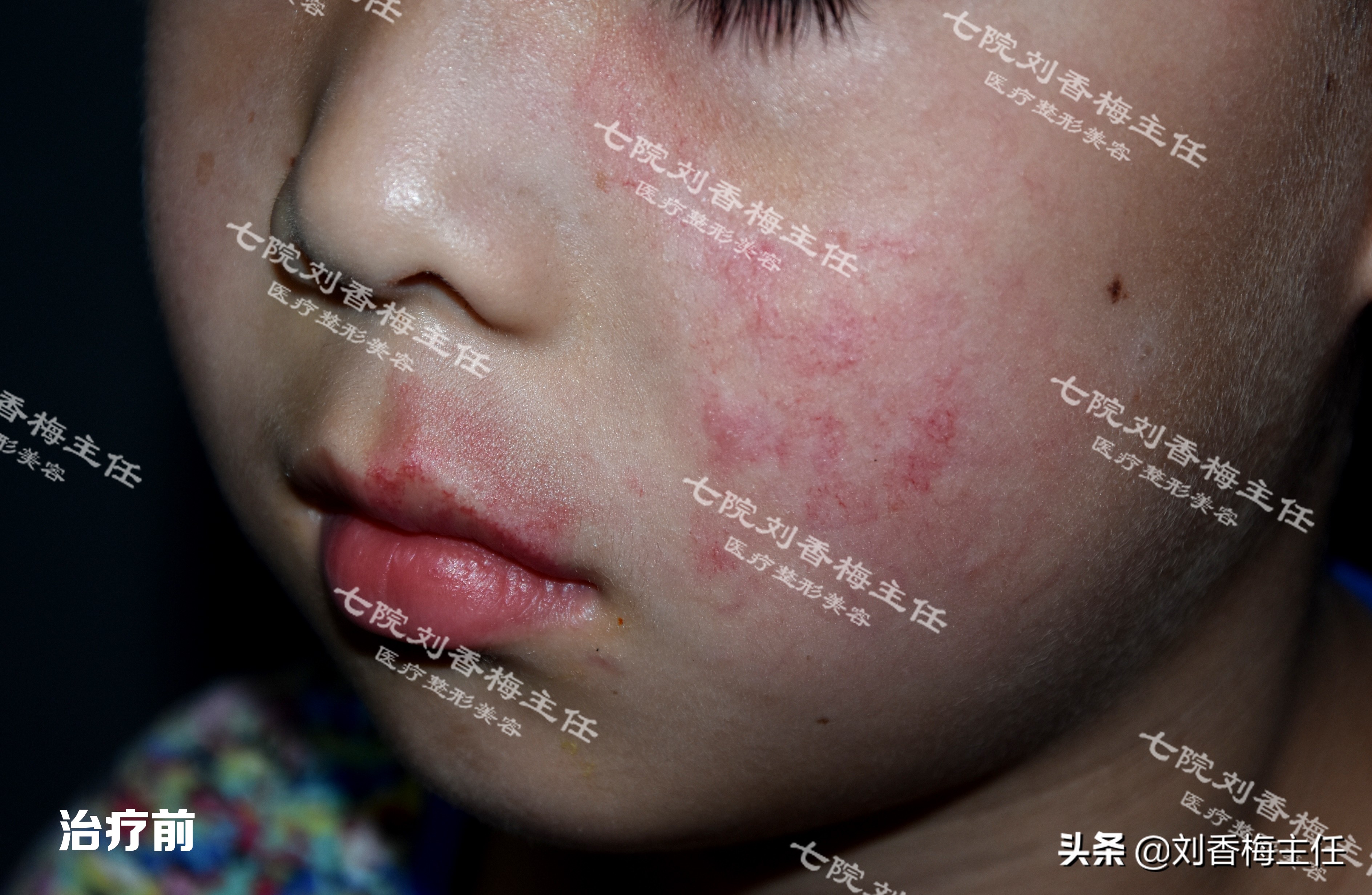 脉冲染料激光治疗鲜红斑痣治愈率,脉冲染料激光治鲜红斑痣效果