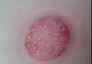 拔罐时出现罐印红是怎么回事,怎样快速消除拔罐留下的罐印