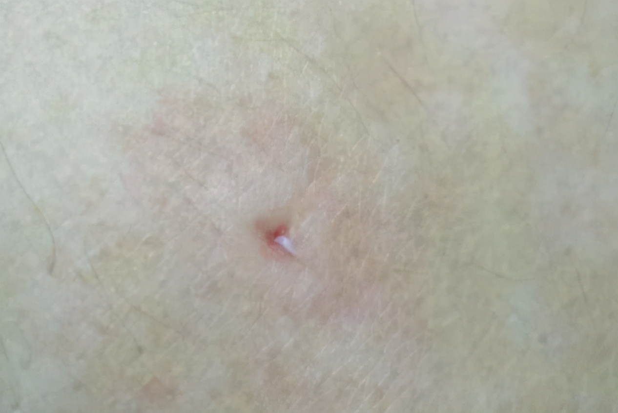 有痔疮的人后背有一道印,有痔疮的人唇上有白点