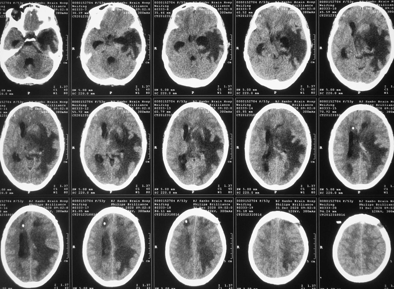 脑脓肿合并脑膜炎需要手术吗,脑脓肿进入左侧脑室严重吗