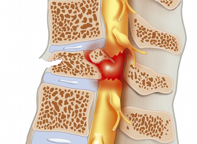 老年人腰酸痛动手术,老年人腰突疼痛建议手术吗
