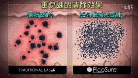 贝克氏母斑是皮秒好还是超皮秒好,皮秒跟超皮秒蜂巢皮秒有什么区别