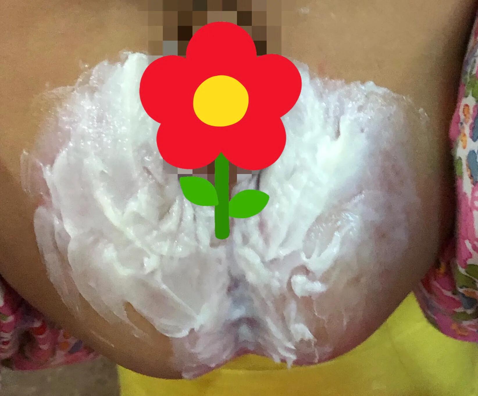 宝宝尿布皮炎什么样,尿布皮炎如何处理