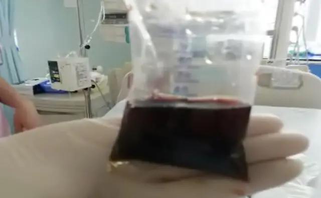 三岁小孩高烧过后全身红点点,3岁宝宝高烧39.5度不退脚冰凉