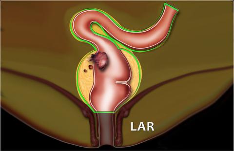 直肠癌“保肛”，你必须知道的知识